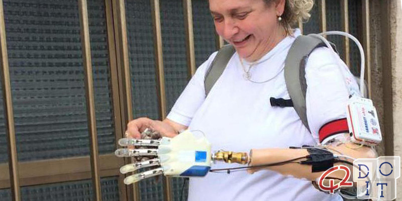 Frau wird zuerst Italiener, um bionische Hand zu bekommen