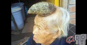 old Chinese lady who is growing a giant cutaneous horn on her forehead