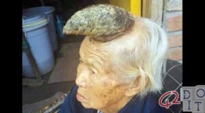 old Chinese lady who is growing a giant cutaneous horn on her forehead