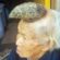 old Chinese lady who is growing a giant cutaneous horn on her forehead