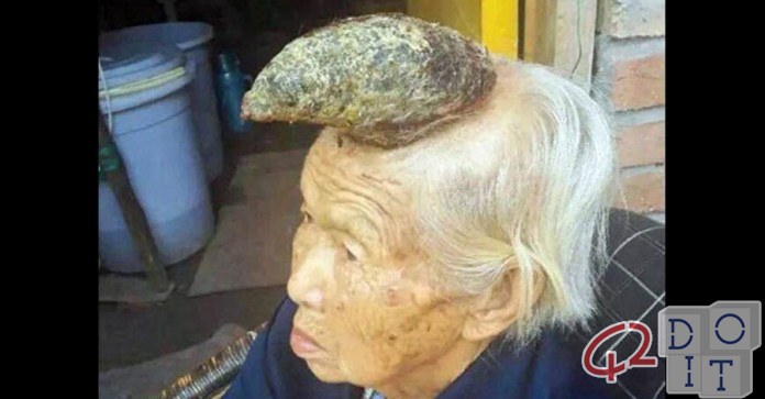 old Chinese lady who is growing a giant cutaneous horn on her forehead
