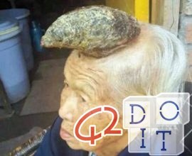 old Chinese lady who is growing a giant cutaneous horn on her forehead