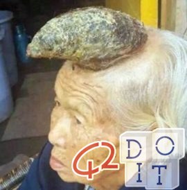 old Chinese lady who is growing a giant cutaneous horn on her forehead