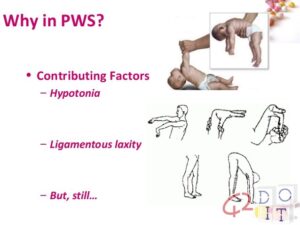 Prader-Willi, the rare genetic disease that makes people obese until they die: what they are, symptoms and treatment