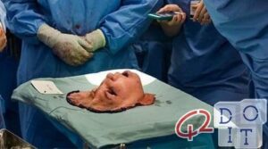 Facial transplant, 16 hours of operation at the Cleveland Clinic in Ohio