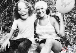 Rocky Dennis, el niño cuya rara deformidad inspiró la película Máscara
